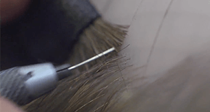 Implanting for CNC hair prosthesis